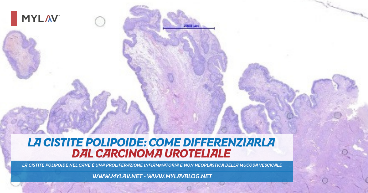 La cistite polipoide: come differenziarla dal carcinoma uroteliale